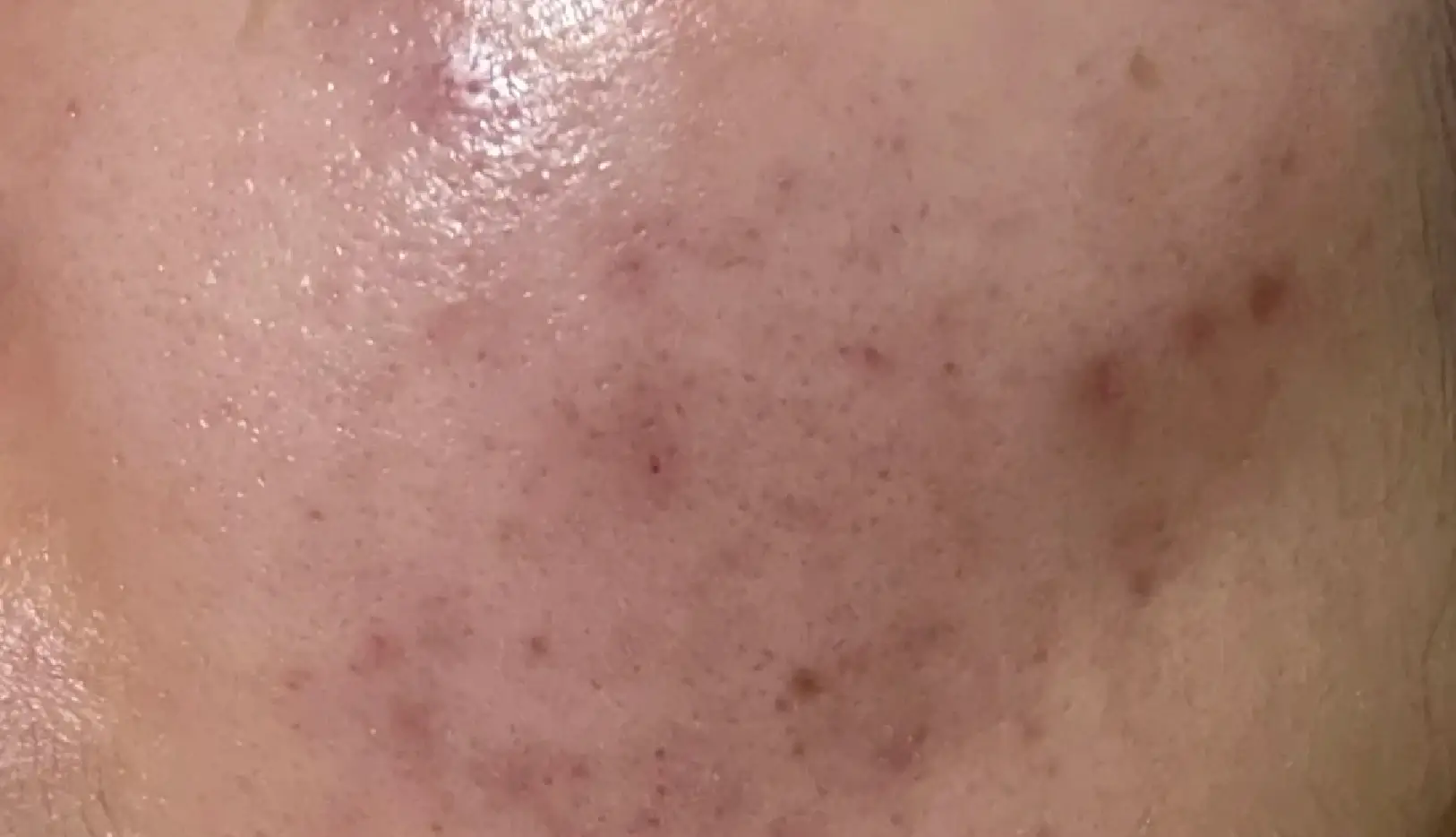 face skin with acne scars
